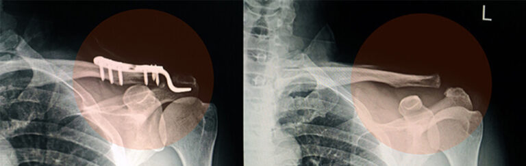 fractured clavicle