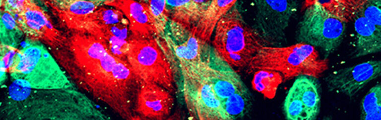 Aggressive Prostate Cancer