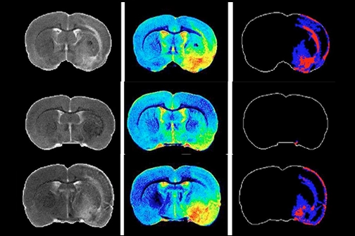 LSU Discovery Helps Ischemic Stroke
